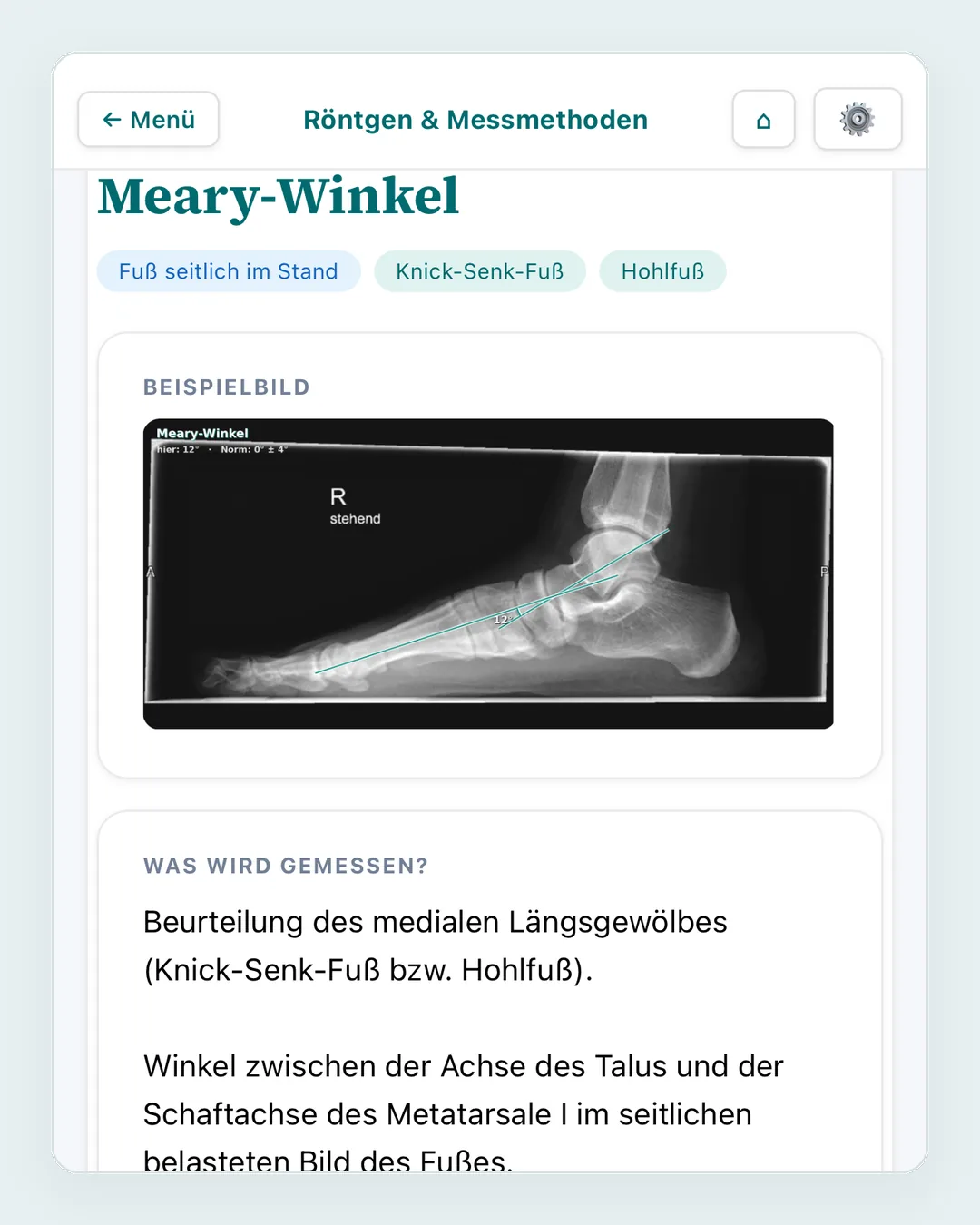 Messmethode Meary-Winkel mit Normwert, Quelle und einer seitlichen Standaufnahme des Fußes mit eingezeichneten Achsen